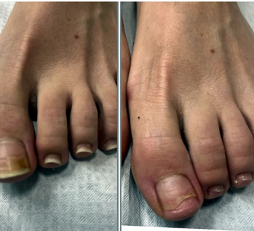 Korekta paznokcia palucha przed i po w gabinecie podologicznym